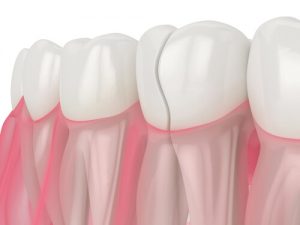hot and cold temperatures grind your teeth not all cracks